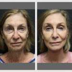 A Before & After Photo of a Facelift Surgery by Dr. Alberico Sessa in Sarasota