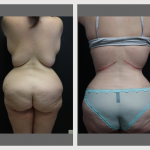 A Before & After Photo of a Midback Plastic Surgery by Dr. Alberico Sessa in Sarasota
