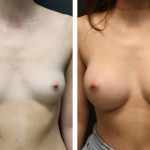 A Before & After Photo of Breast Augmentation Plastic Surgery by Dr. Alberico Sessa in Sarasota