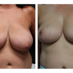 A Before and After Photo of Breast Lift Plastic Surgery by Dr. Alberico Sessa in Sarasota