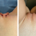 A Before & After Photo of Labiaplasty Plastic Surgery by Dr. Alberico Sessa in Sarasota