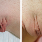 A Before & After Photo of Labiaplasty Plastic Surgery In Sarasota