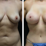 A Before and After Photo of a Mommy Makeover Plastic Surgery by Dr. Alberico Sessa in Sarasota
