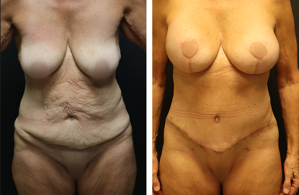 A Before and After Photo of Body Lift Plastic Surgery by Dr. Alberico Sessa in Sarasota