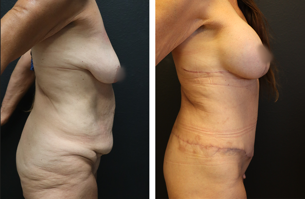 A Before and After Photo of Body Lift Plastic Surgery by Dr. Alberico Sessa in Sarasota