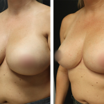 A Before Photo of a Breast Lift Plastic Surgery by Dr. Alberico Sessa in Sarasota