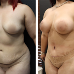 Mommy Makeover Procedure Before After Images Patient 23