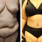 A Before & After Photo of a Tummy Tuck Plastic Surgery by Dr. Alberico Sessa in Sarasota