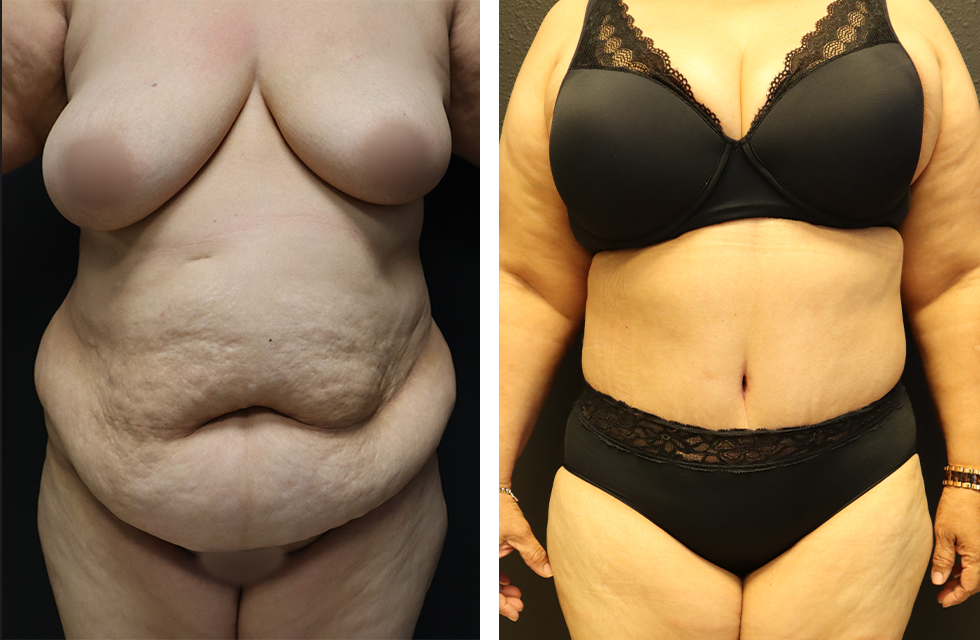 A Before & After Photo of a Tummy Tuck Plastic Surgery by Dr. Alberico Sessa in Sarasota