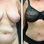 Before & After Photos of a Tummy Tuck Plastic Surgery by Dr. Alberico Sessa in Sarasota