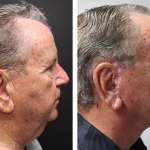 A Before & After Photo for a Facelift Plastic Surgery by Dr. Alberico Sessa in Sarasota