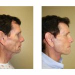 A Before & After Photo of a Male Facelift Plastic Surgery by Dr. Alberico Sessa in Sarasota