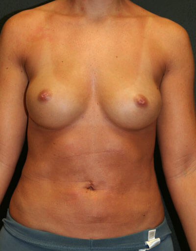 Fat Transfer to Breasts Front View Sarasota Surgical Arts
